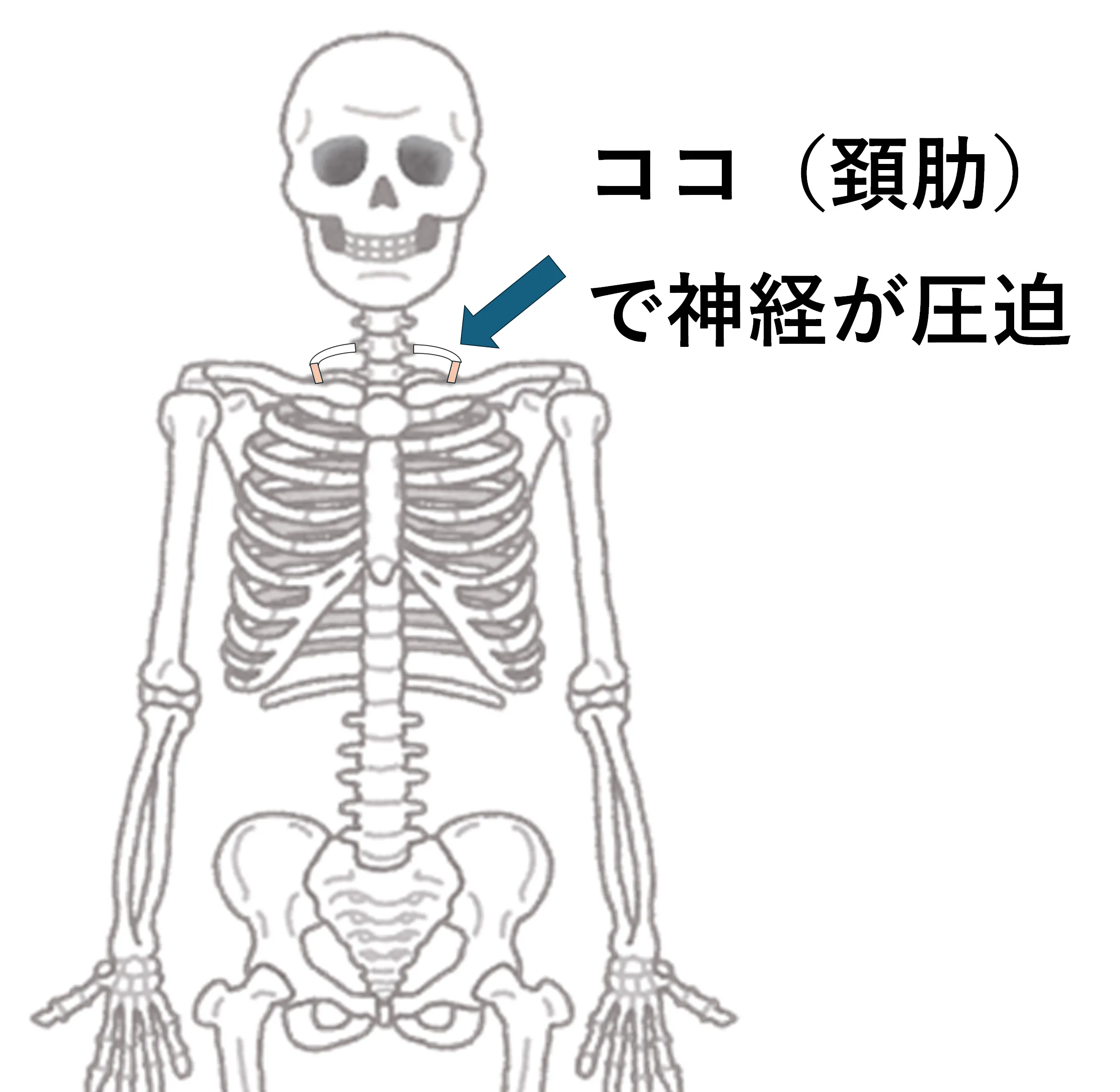 頚肋症候群